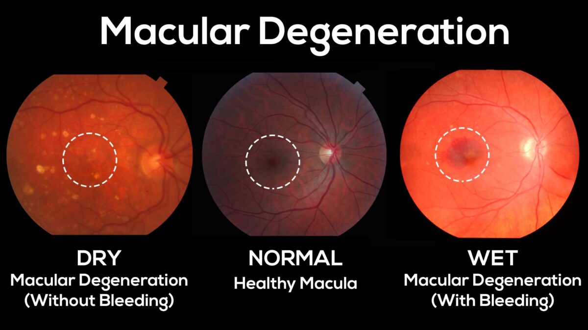 macular-degeneration-1200x675.jpg
