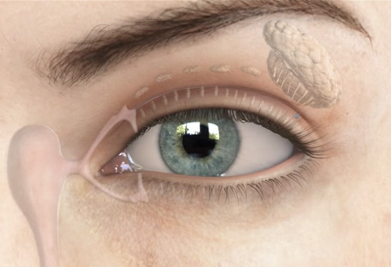 Dry Eye