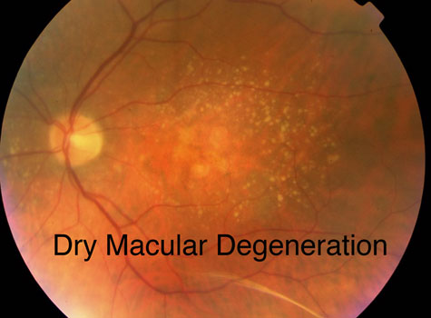 dry_macular_degeneration.jpg