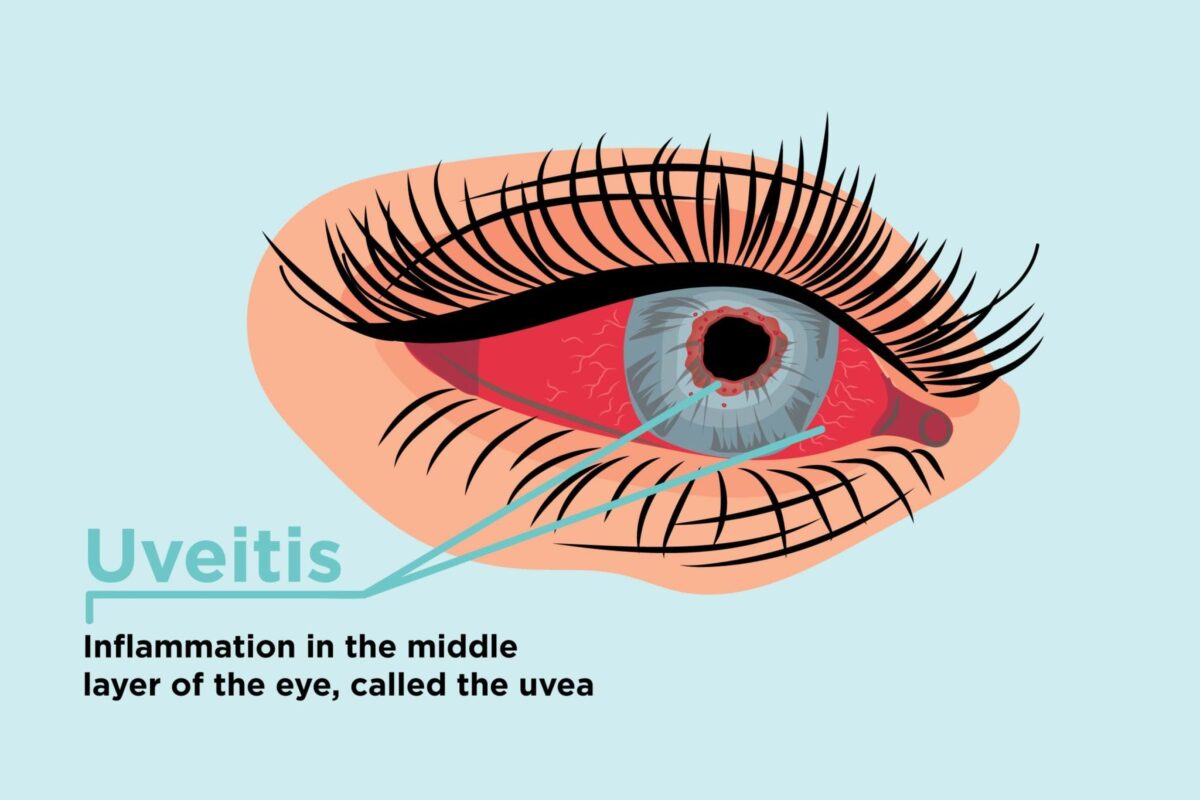 1018_Uveitis-1200x800.jpg