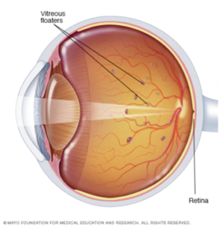 EYE FLOATERS