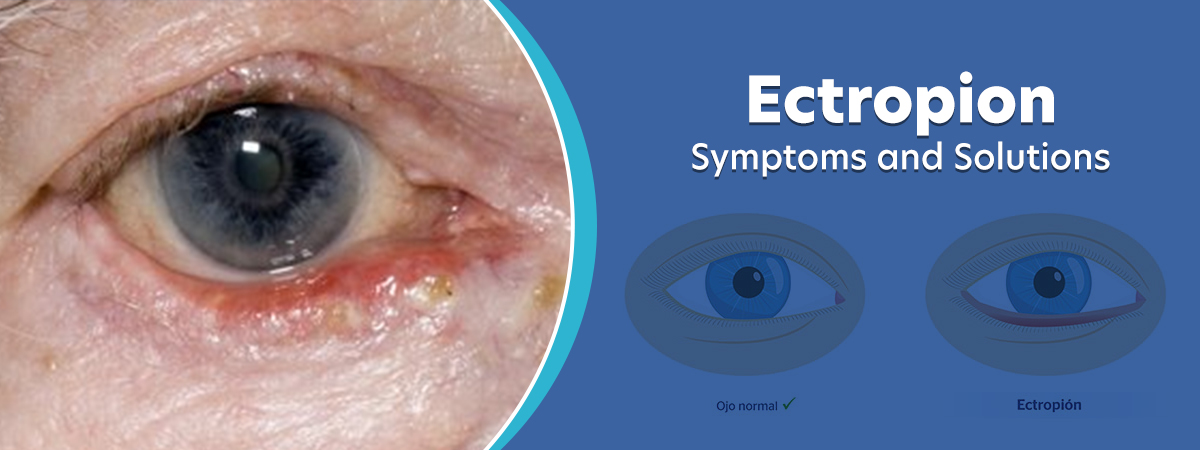 Ectropion.jpg